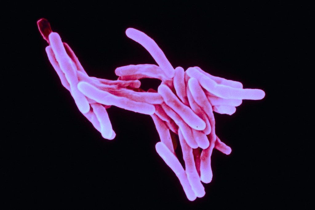 Rapid diagnosis of TB meningitis is imperative and a biomarker-based test is needed: We need to move beyond detecting the bacilli to combat TBM mortality!